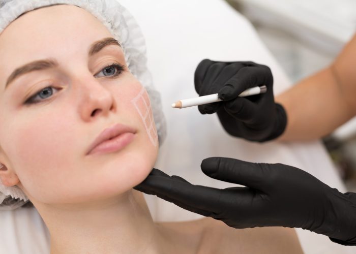 Beautician draws the contours of a white pencil on the face of the patient. Schematic marking before contouring. Close-up preparation of the face for cosmetic plastic surgery